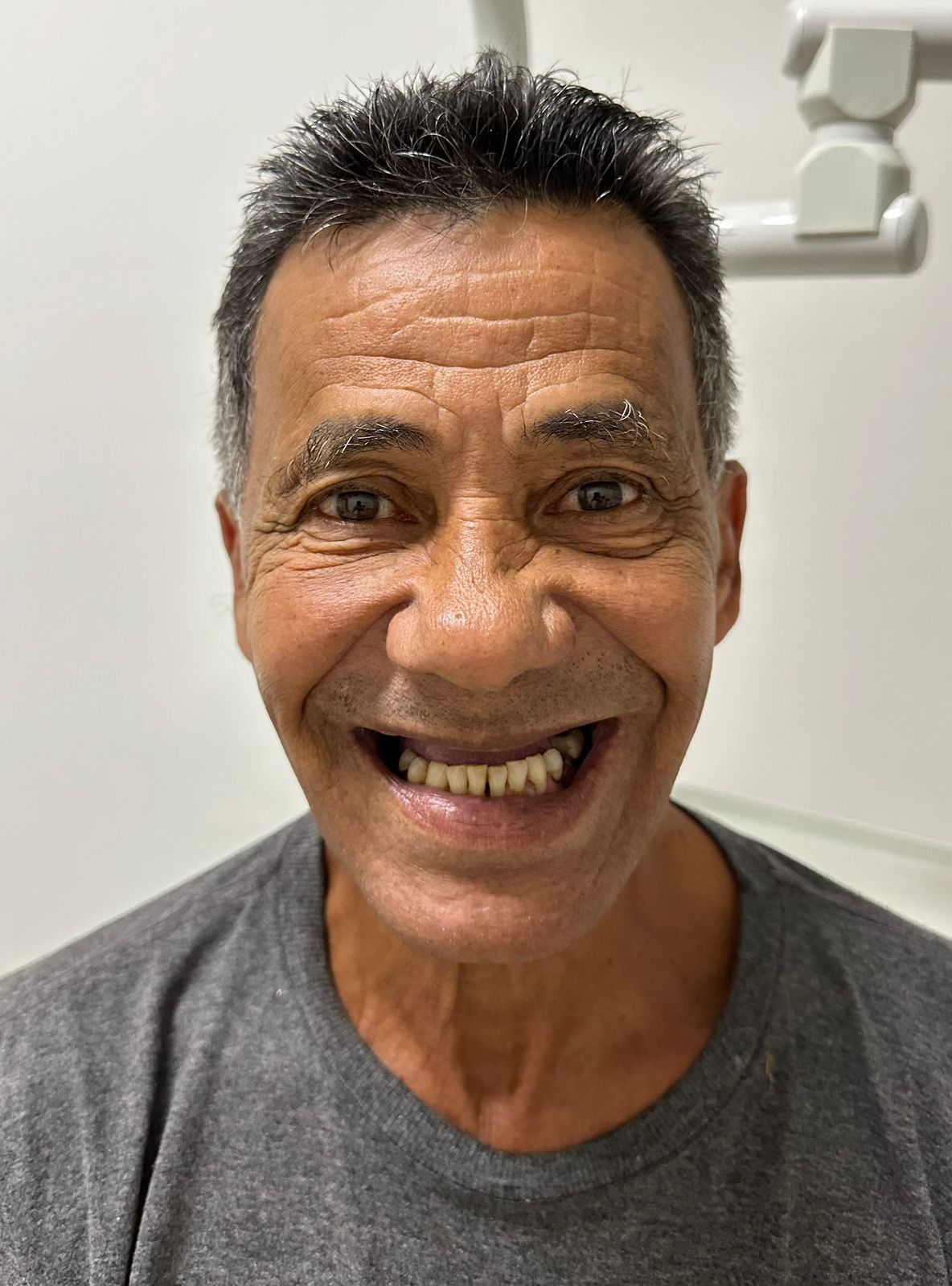 José Antonio antes da reabilitação oral, com ausência de dentes na arcada superior.